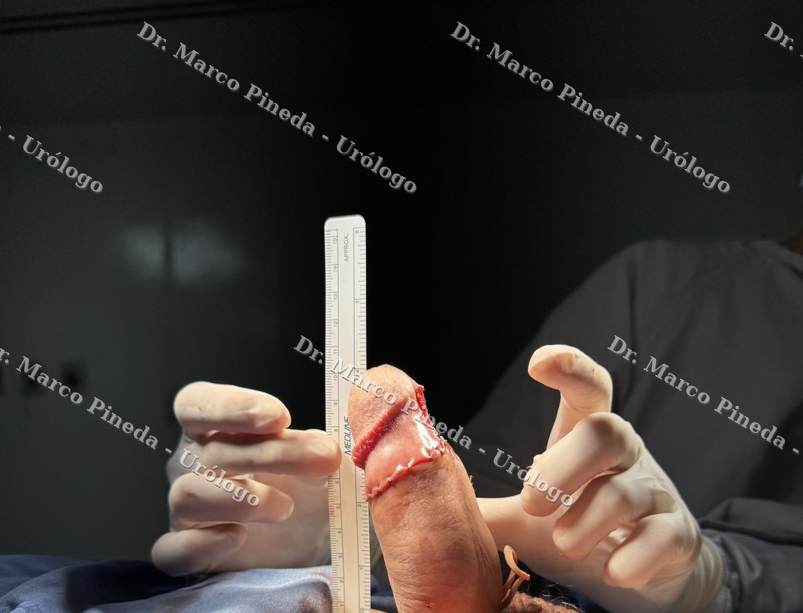 Postoperative result with surgical ruler showing straight shaft