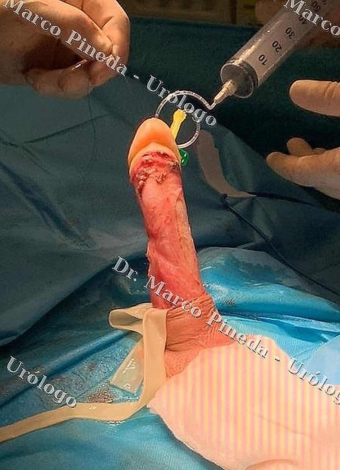 Postoperative result after plication correction